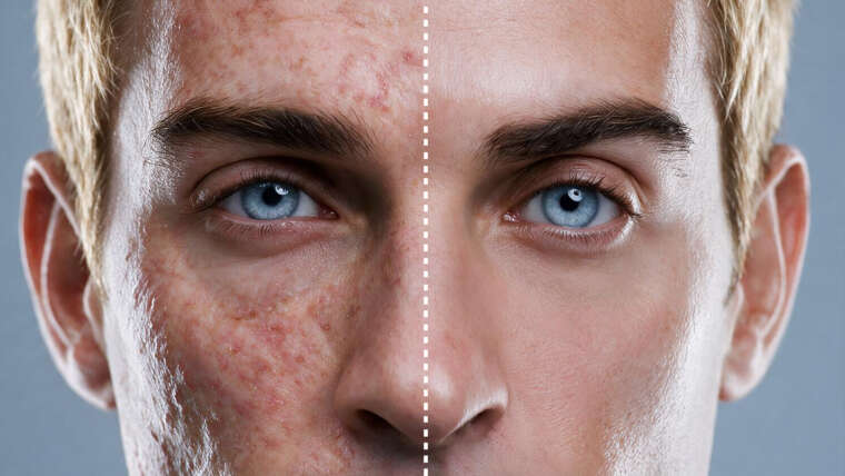 Male Treatments